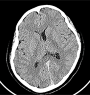 Apeikonish Egkefalou